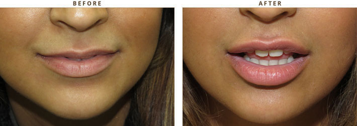 Lip lift - Before and After Pictures