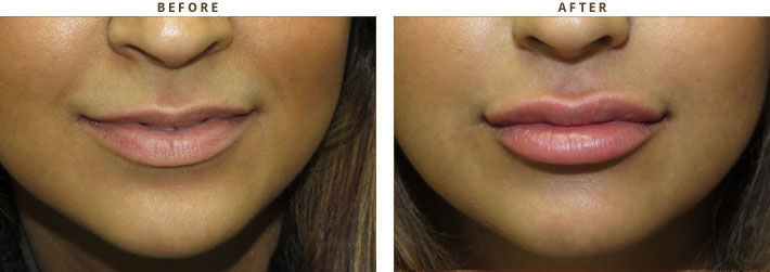 Lip lift - Before and After Pictures