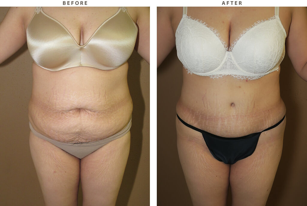 Liposuction - Before and After Pictures