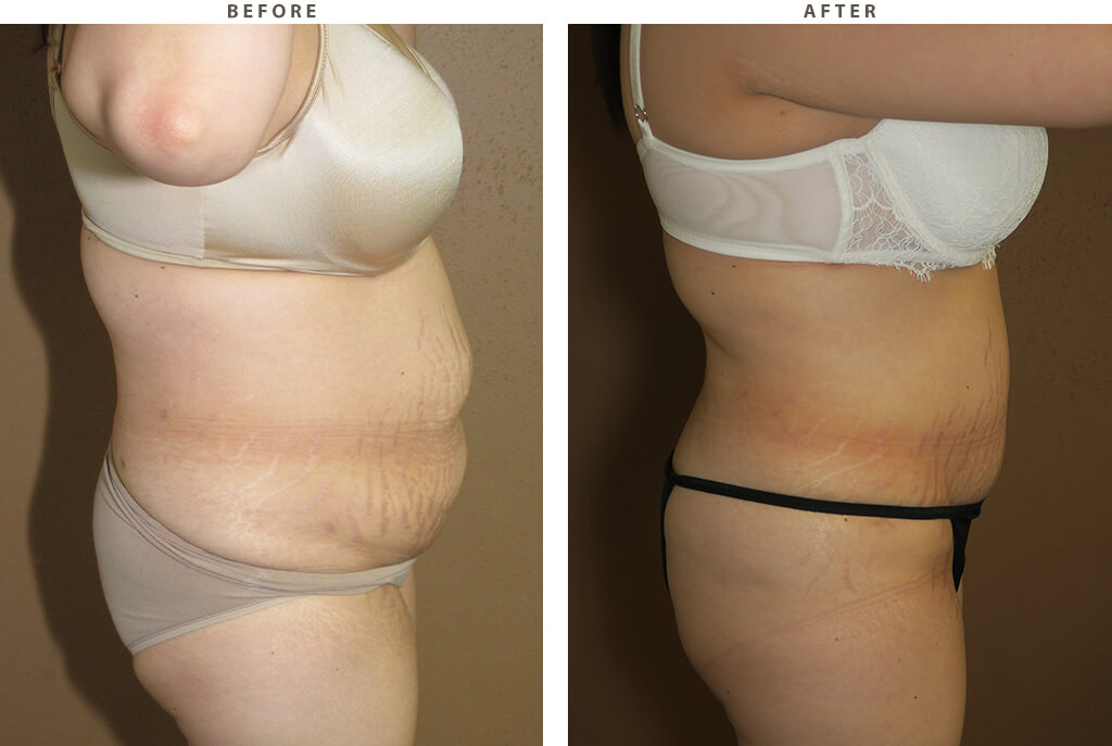Liposuction - Before and After Pictures