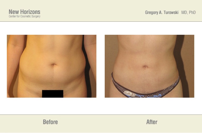 Liposuction - Before and After Pictures