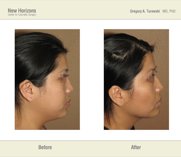 Liposuction - Before and After Pictures