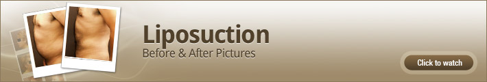 Liposuction – Before and After Pictures