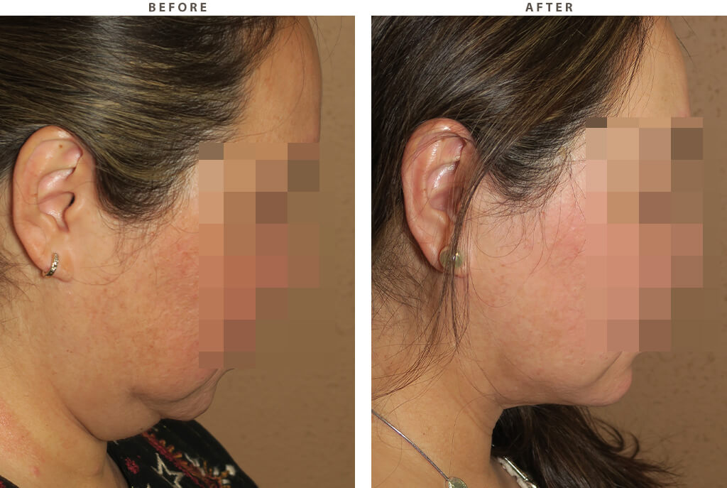 Liposuction of the neck - Before and After Pictures