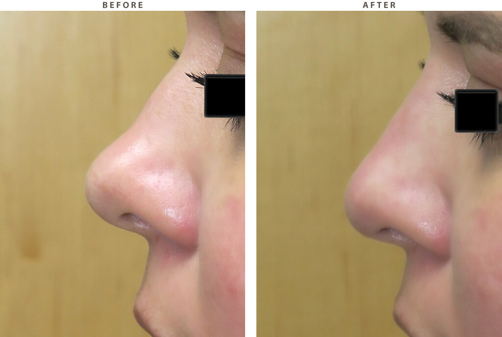 Liquid rhinoplasty - Before and After Pictures