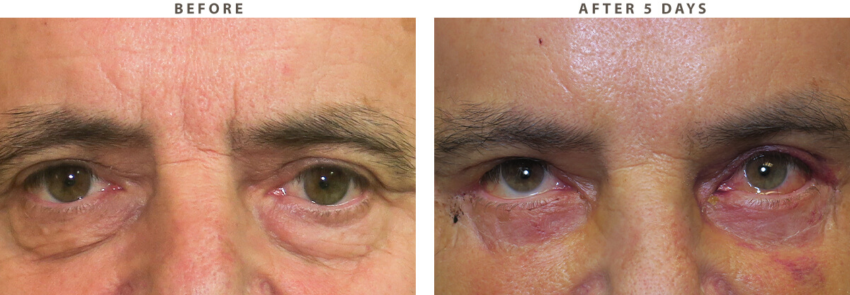 Lower Blepharoplasty Chicago - Before and After Pictures
