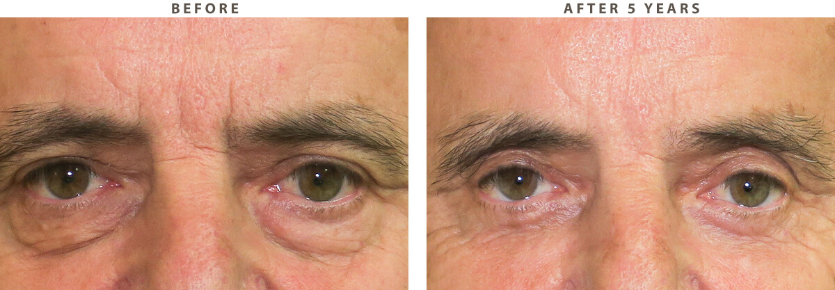 Lower Blepharoplasty Chicago - Before and After Pictures