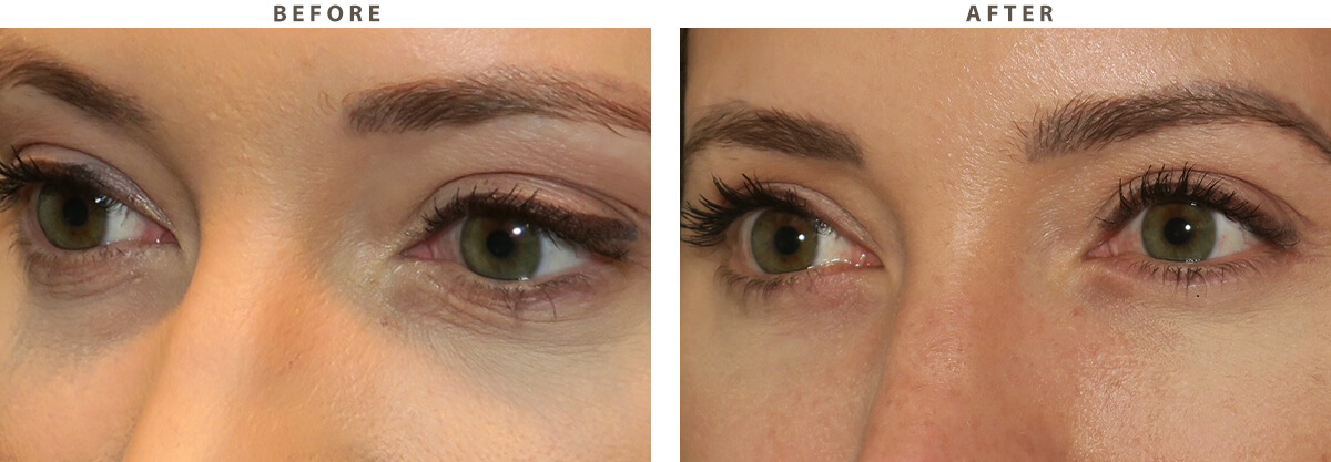 Lower Blepharoplasty - Before and After Pictures