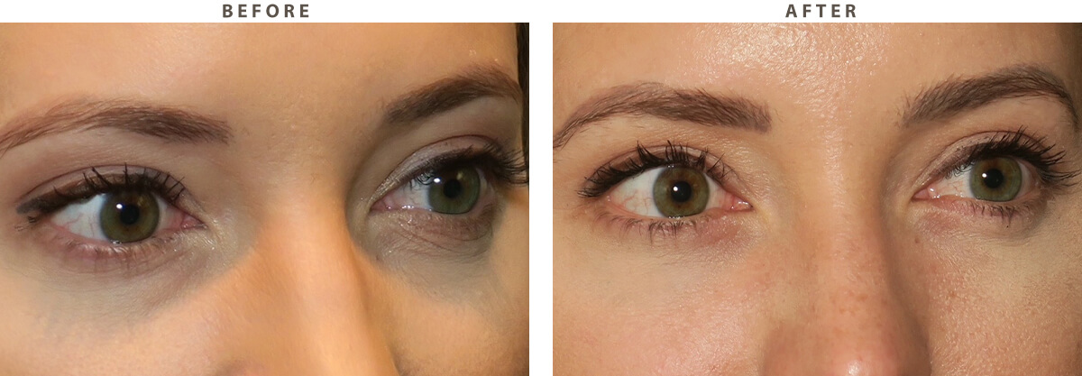Lower Blepharoplasty - Before and After Pictures