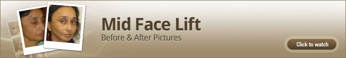 Mid Face Lift – Before and After Pictures