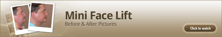 Mini Face Lift – Before and After Pictures