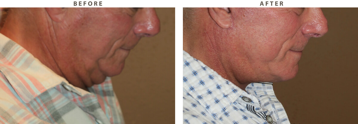 Neck Lift - Before and After Pictures