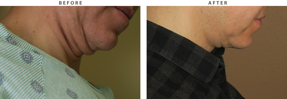 Neck Lift - Before and After Pictures