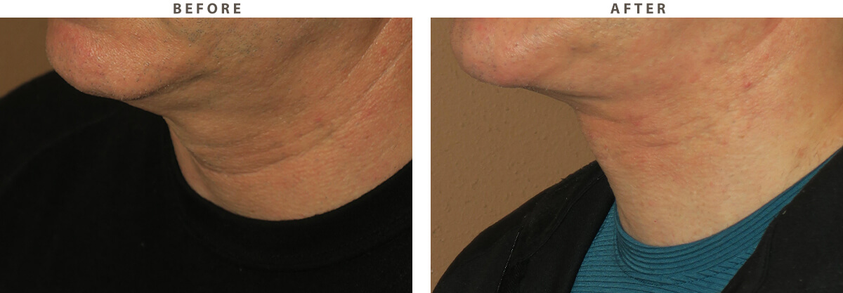 Neck Lift Chicago - Before and After Pictures