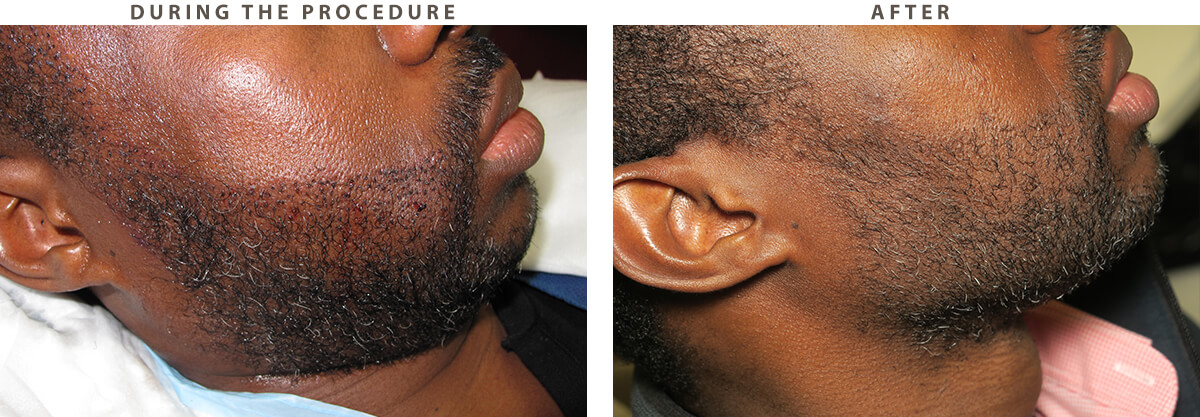 NeoGraft - Before and After Pictures