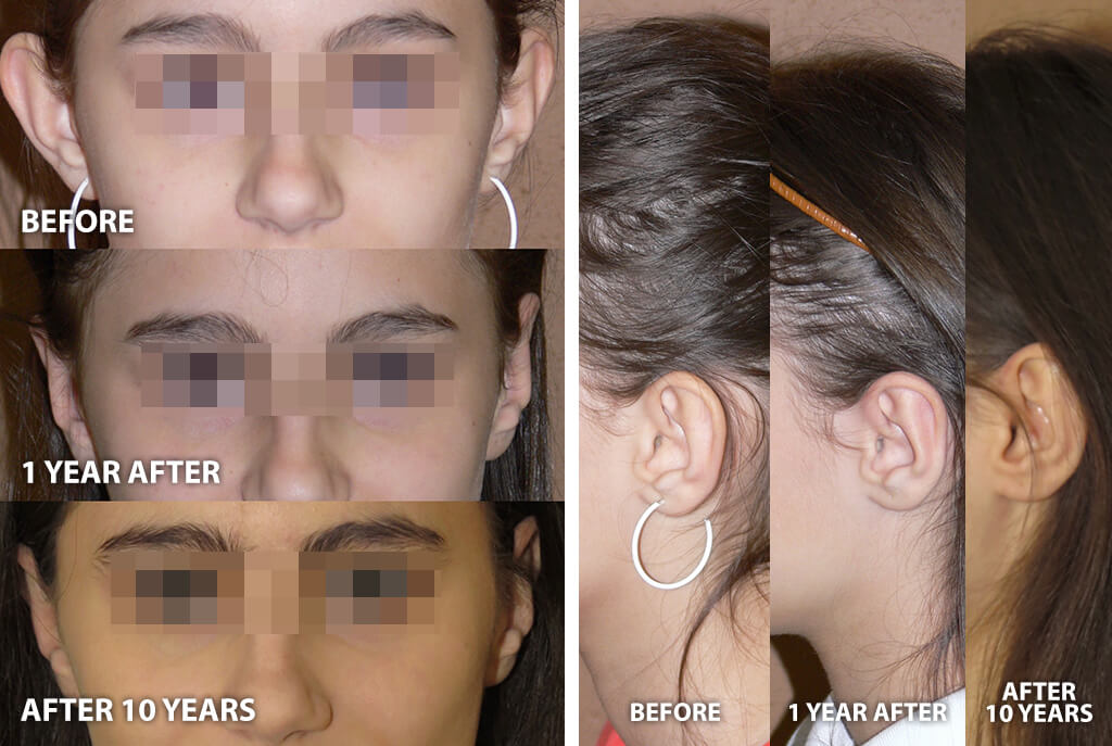 Otoplasty - Before and After Pictures