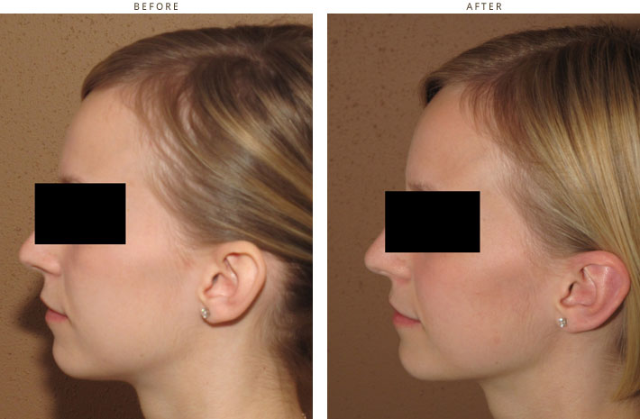 Otoplasty (Ear Setback) - Before & After Pictures