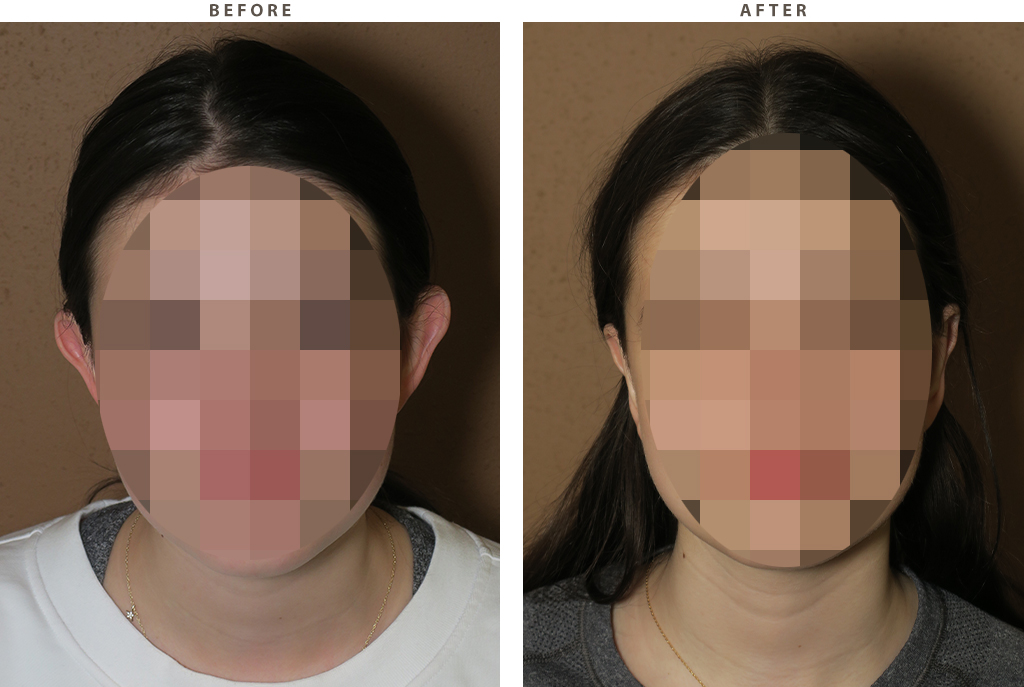 Otoplasty Chicago - Before and After Pictures