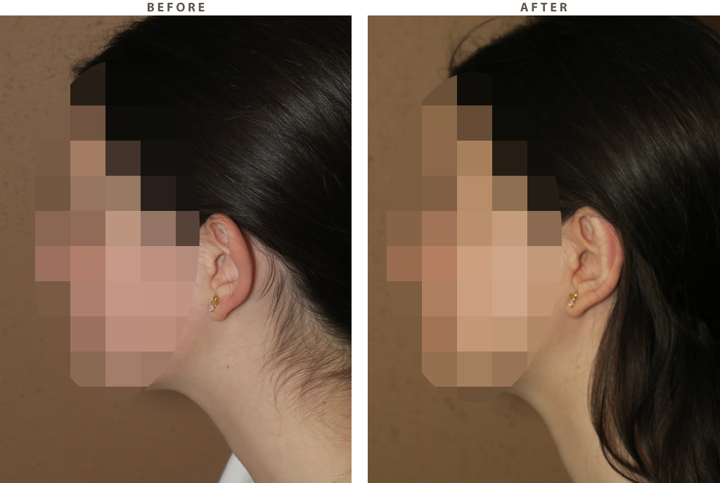 Otoplasty Chicago - Before and After Pictures