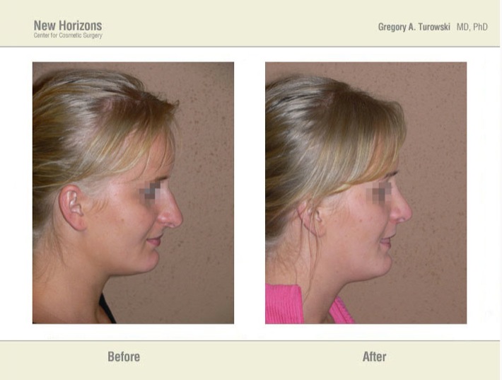 Rhinoplasty – Before and After Pictures