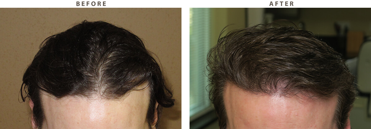 Robotic Hair Transplant - Before and After Pictures