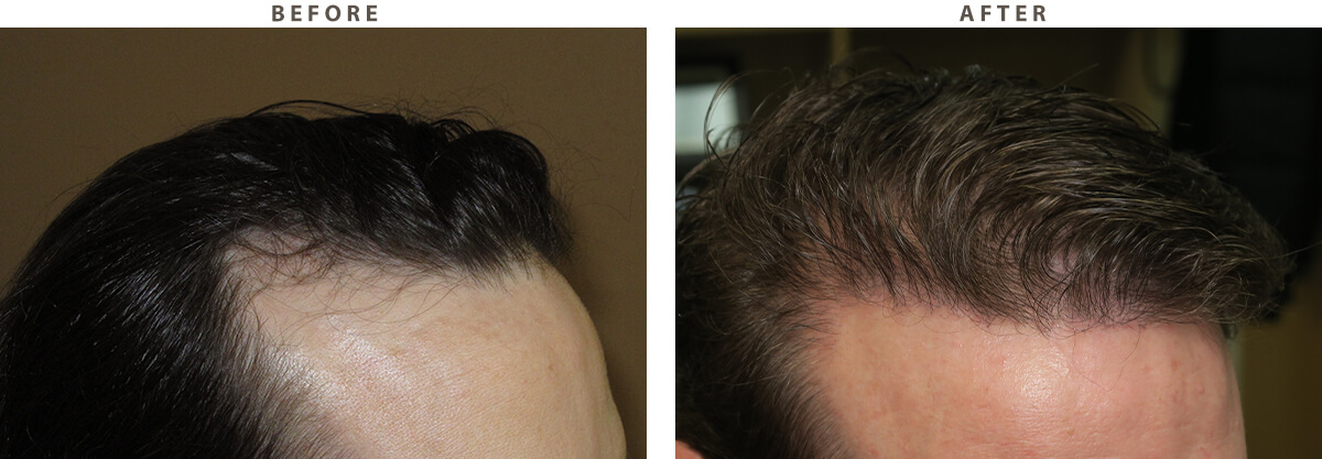Robotic Hair Transplant - Before and After Pictures