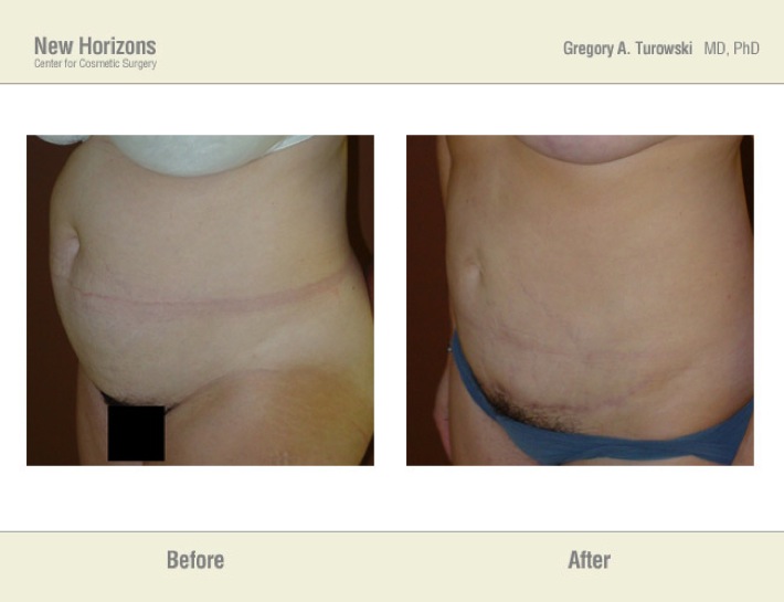 Tummy Tuck (Abdominoplasty) – Before & After Pictures Tummy Tuck (Abdominoplasty) – Before & After Pictures