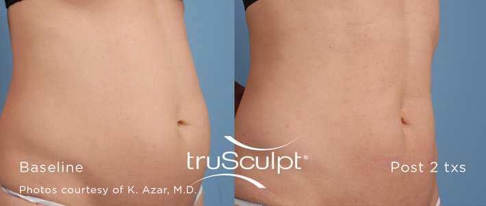 truSculpt Body - berore and after pictures