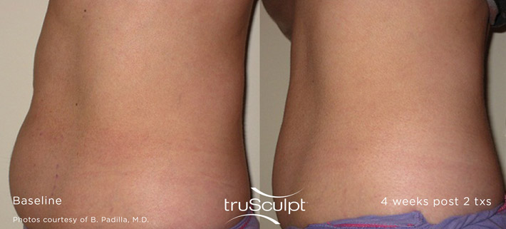 truSculpt Body - berore and after pictures