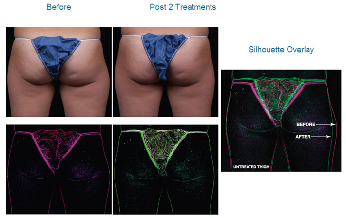 truSculpt Body - berore and after pictures