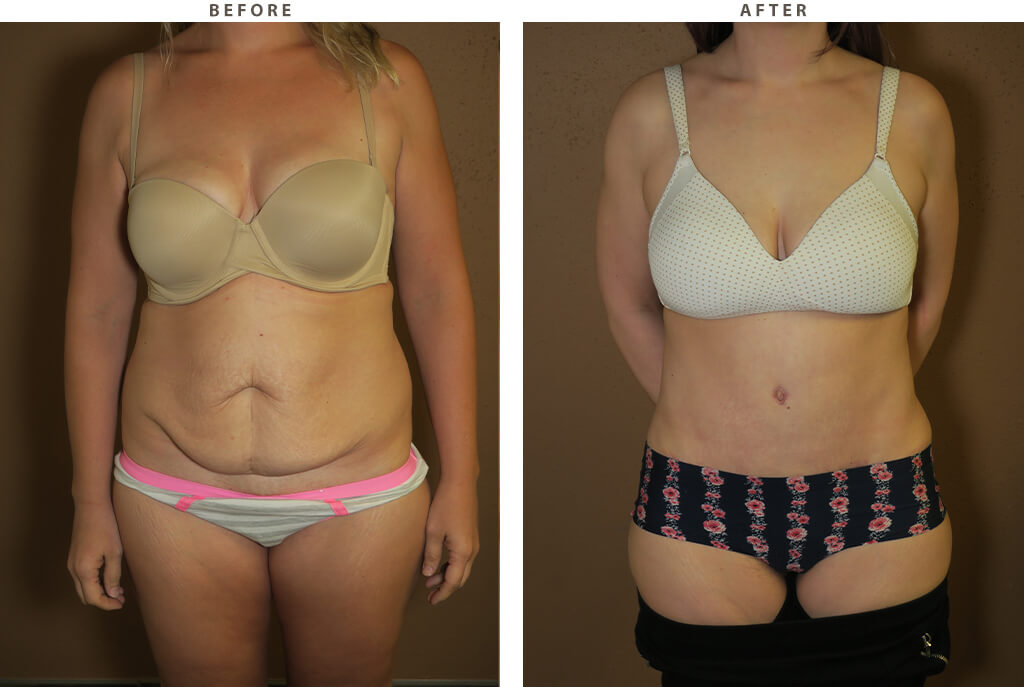 Tummy Tuck - Before and After Pictures