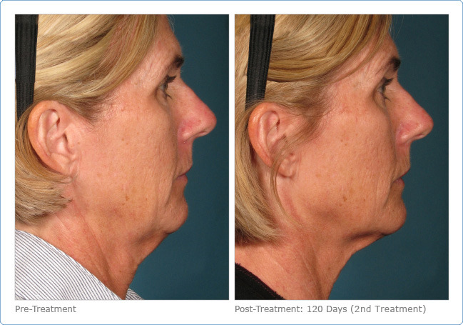 Ultherapy - Before & After Pictures