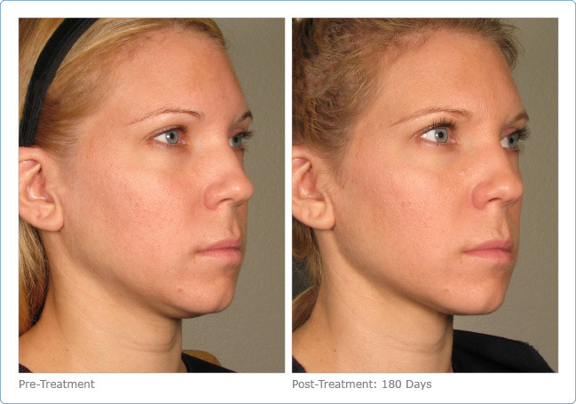 Ultherapy - Before & After Pictures