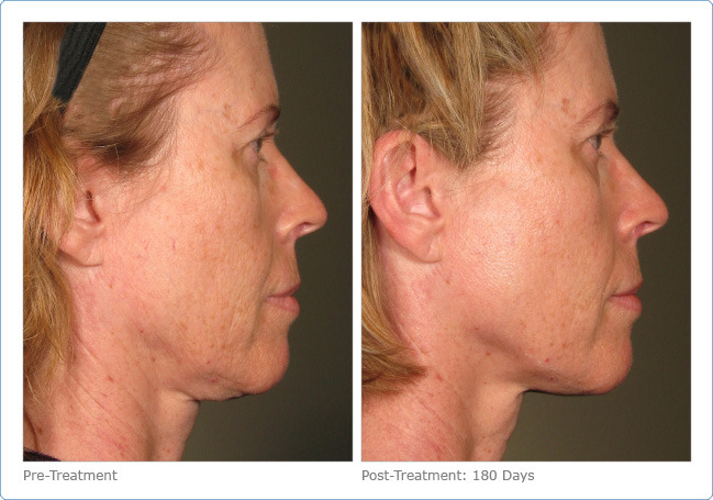 Ultherapy - Before & After Pictures