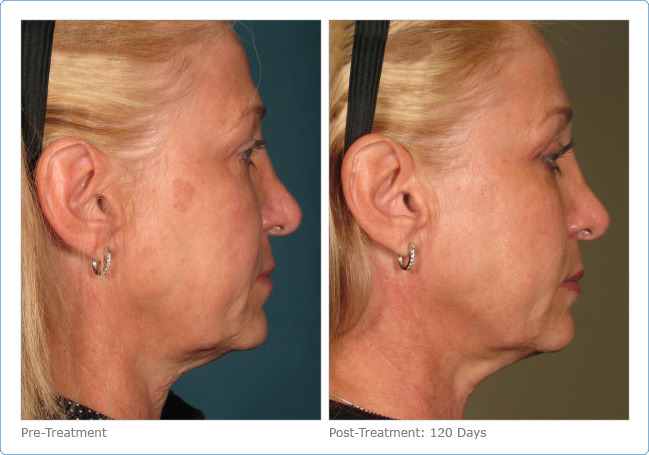 Ultherapy - Before & After Pictures