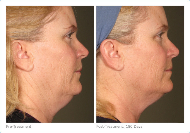 Ultherapy - Before & After Pictures