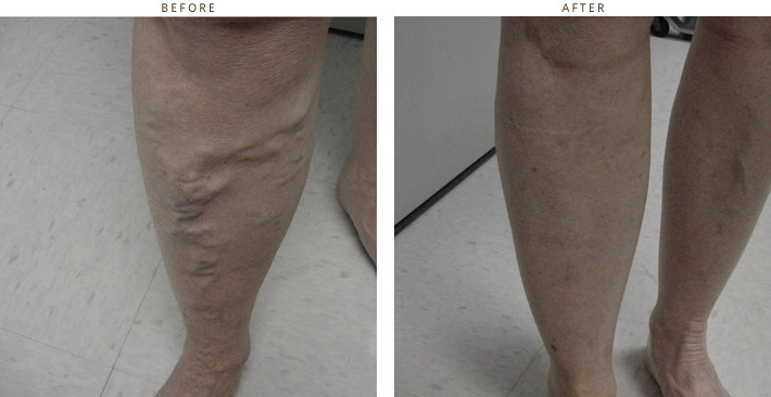 Varicose Veins - Before and After Pictires