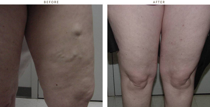 Varicose Veins - Before and After Pictires