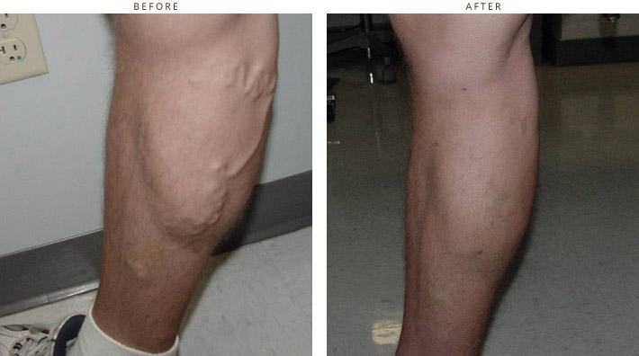 Varicose Veins - Before and After Pictires