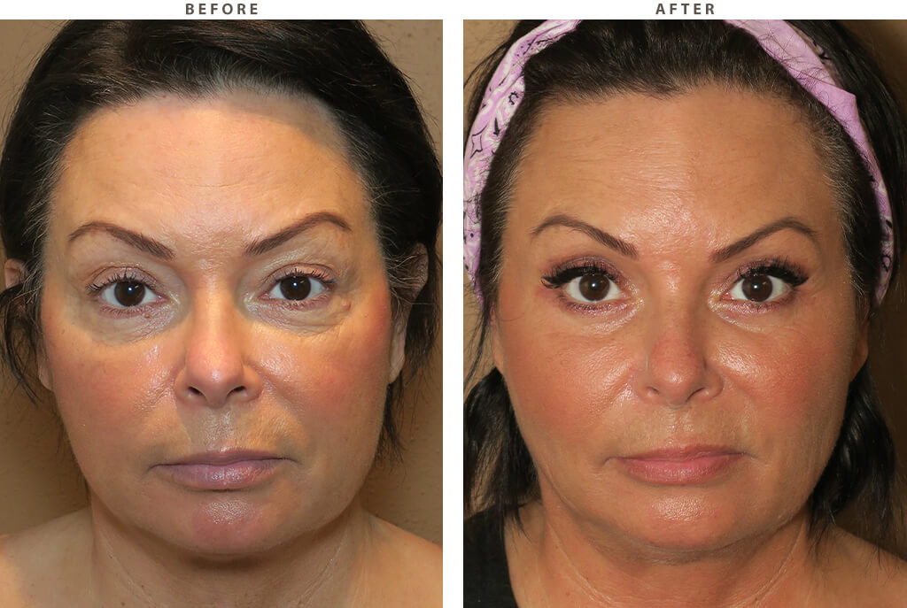 Mid Face Lift Before And After Pictures Dr Turowski Plastic Surgery Chicago