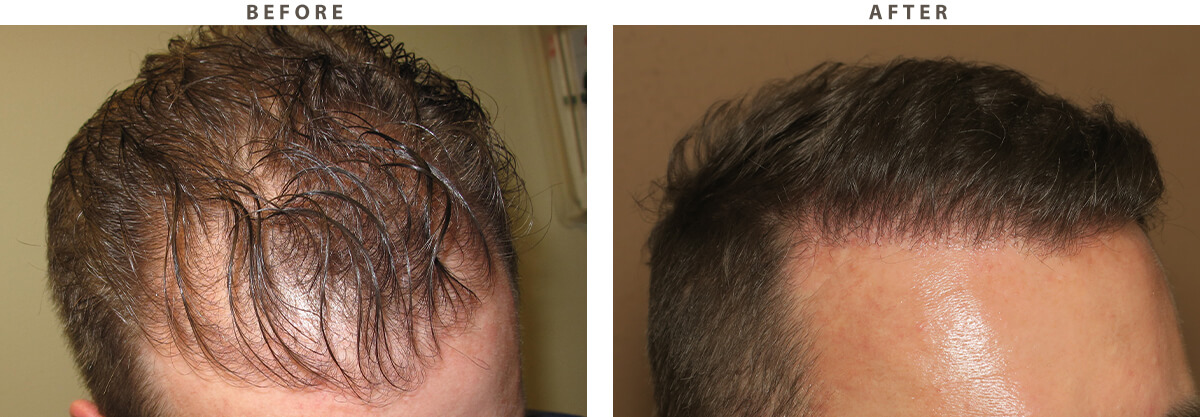 FUE Hair Transplantation – Before and After Pictures * | Dr Turowski -  Plastic Surgery Chicago