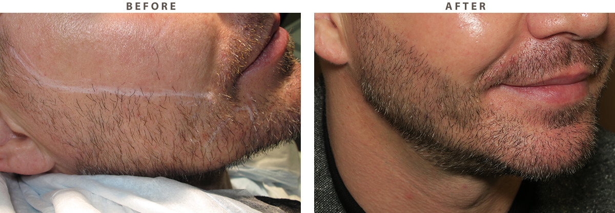Facial Hair Transplant – Before and After Pictures * | Dr Turowski -  Plastic Surgery Chicago