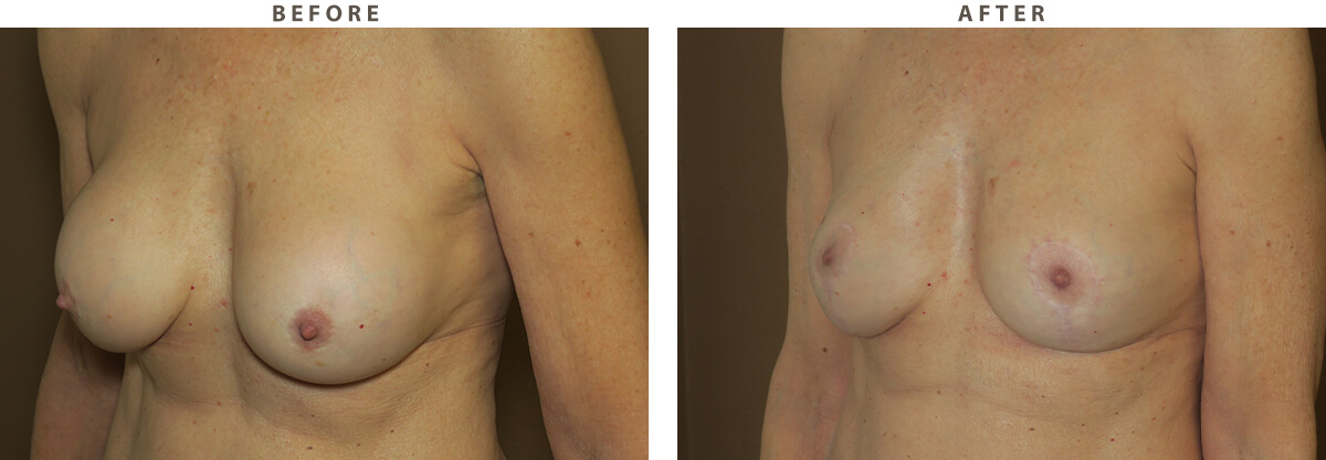 Breast implant removal Chicago - Before and After Pictures