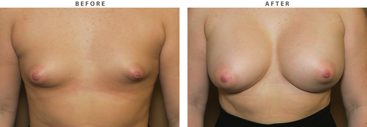 Tuberous breast correction Chicago - Before and After Pictures