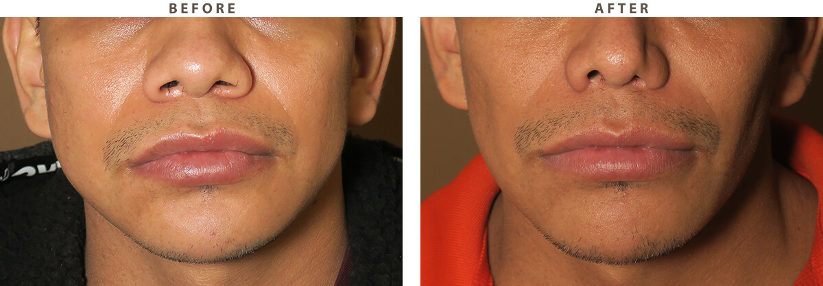 Buccal Fat Pad Removal Before And After Pictures Dr Turowski