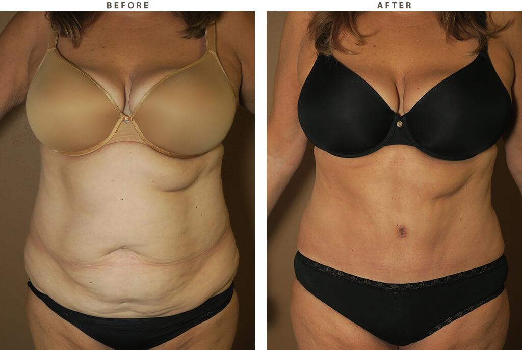 Tummy Tuck (Abdominoplasty) – Before & After Pictures *