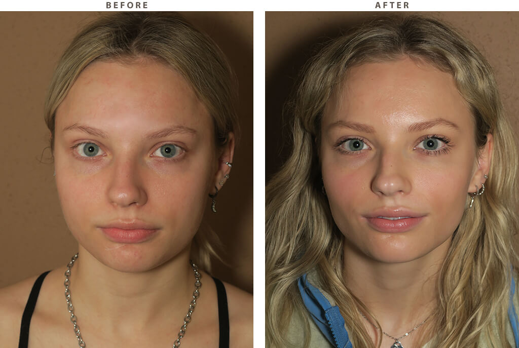 Imagen relevante de Bichectomía