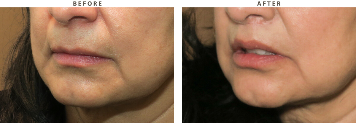 Lip lift Chicago - Before and After Pictures