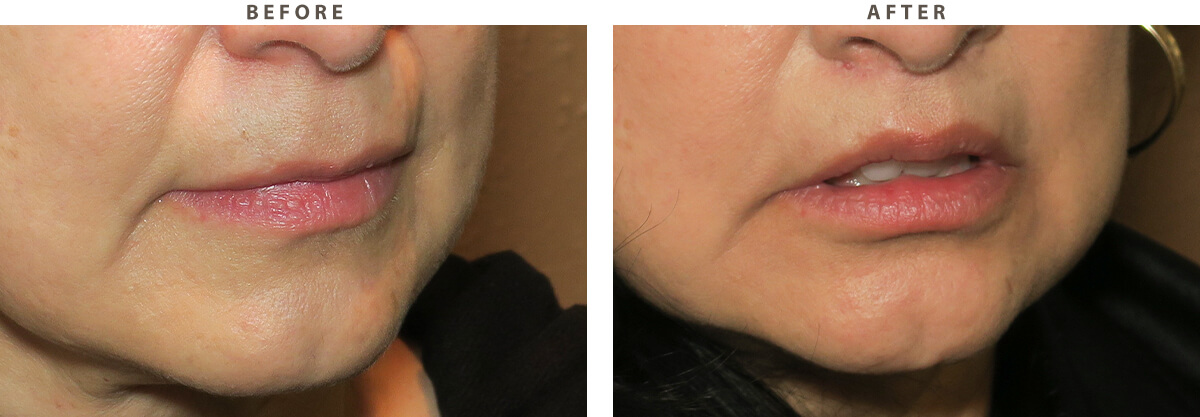 Lip lift Chicago - Before and After Pictures