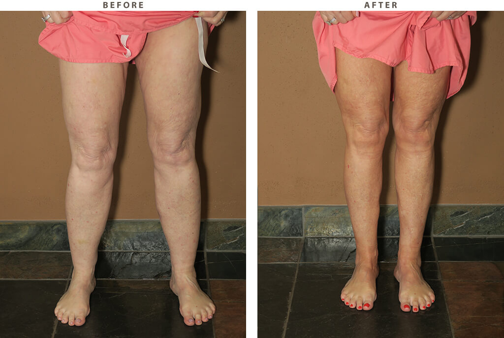 Liposuction Chicago - Before and After Pictures